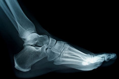 Os ossos do tarso incluir a parte de baixo do tornozelo, o grande calcâneo ou o osso do calcanhar e os ossos mais pequenos na parte de trás do arco.  Os ossos longos na parte da frente do arco são os metatarsos.